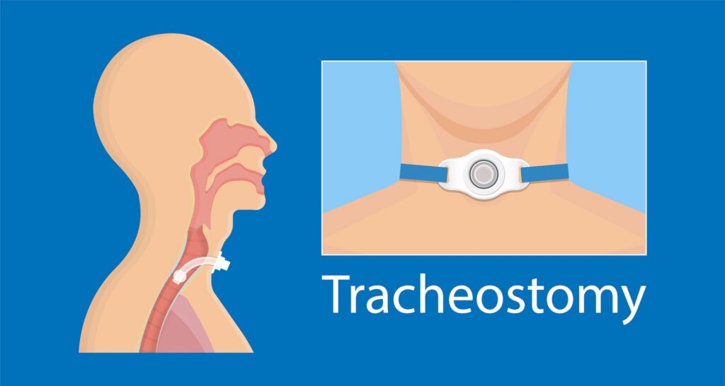 What Does Tracheostomy Rehabilitation Involve?