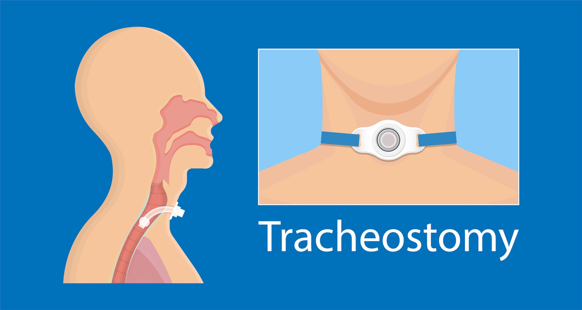 What Does Tracheostomy Rehabilitation Involve?